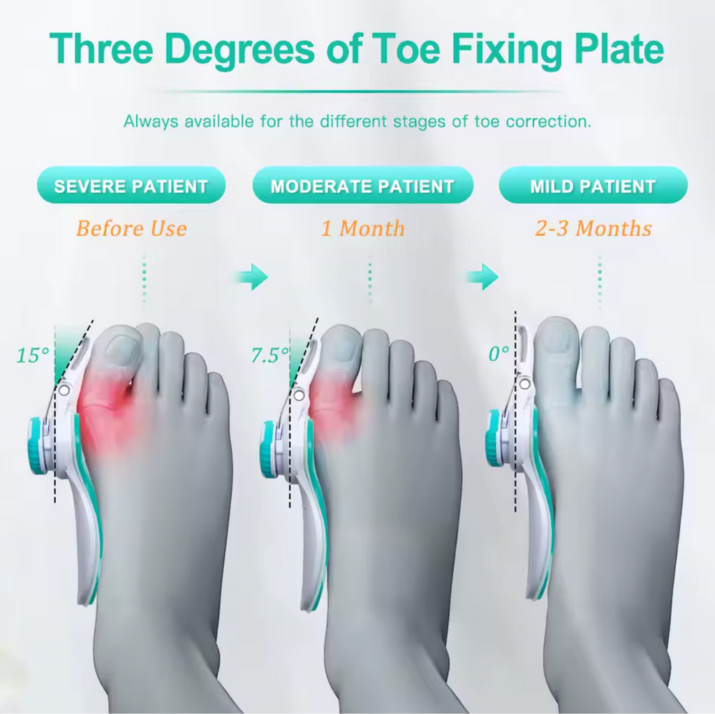 AlignEase™ Toe Corrector | Bunion & Toe Alignment Support