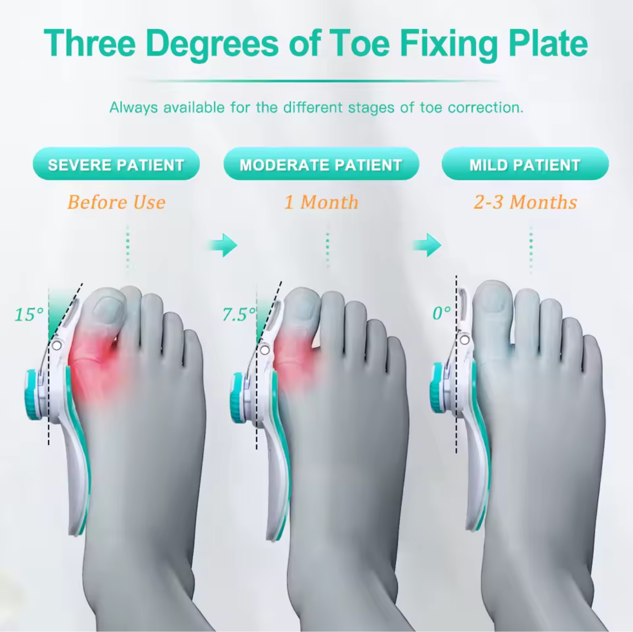 AlignEase™ Toe Corrector | Bunion & Toe Alignment Support