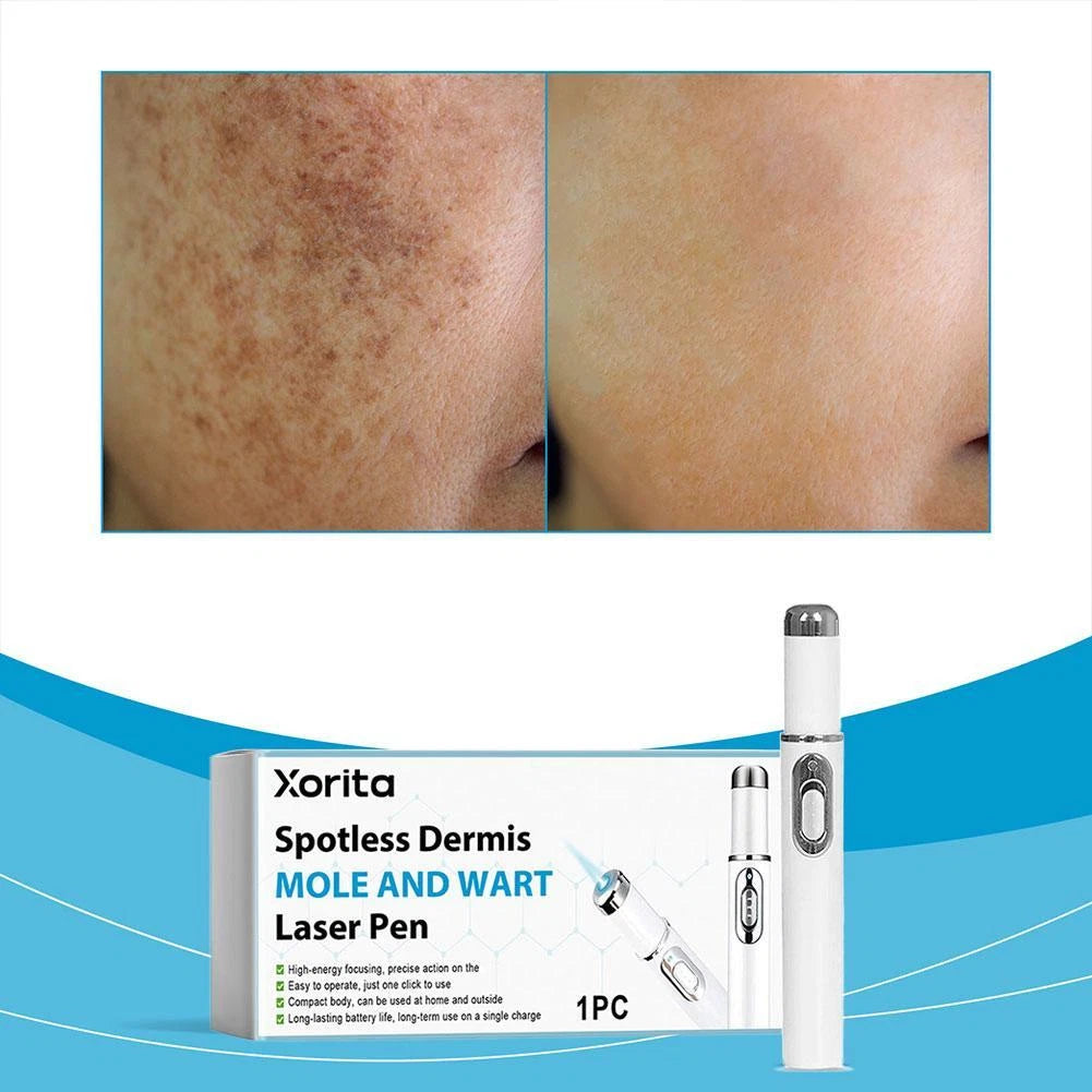 Mole & Wart Removal Laser Pen